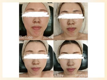 ソウナ(SONA)/厳選国産ハーブピーリング