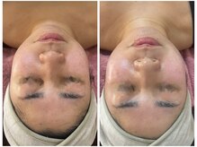 シャイネル(SHYNELL)/アンストレス1回のお写真です！