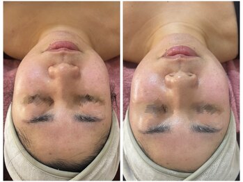 シャイネル(SHYNELL)/アンストレス1回のお写真です!