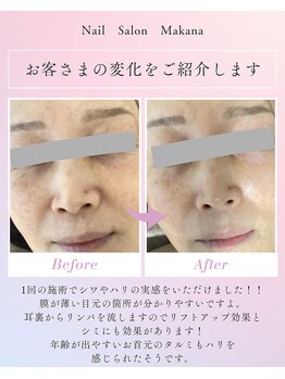 マカナ(Makana)/ララピール＋ゲル(Before After)