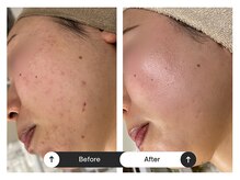 リジュ(Reje)/赤み&ニキビケア