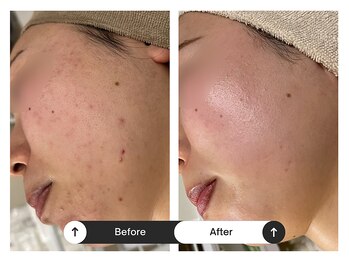 リジュ(Reje)/赤み&ニキビケア