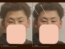 クレスト(CREST)/ビフォーアフター【小顔名古屋】
