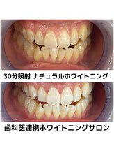 プラチナムビューティ 四条烏丸店(PLATINUM Beauty)/ホワイトニングビフォーアフター