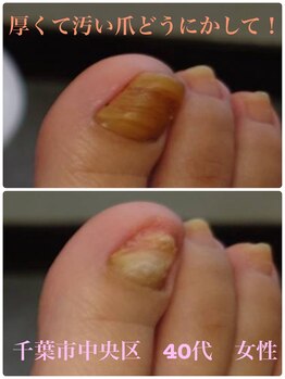 巻き爪じゅん 船橋店/厚く汚い爪サンダル時期までに