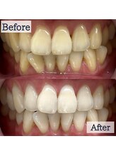 LBSホワイトニング 錦糸町店/ホワイトニングビフォーアフター