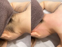 キカ(kika)/うなじワックス＋美容脱毛
