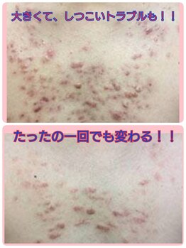 キッカ 梅田天六(Kikka)/デコルテ・お尻・腰回りトラブル