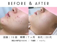 ロエヴェ(ROEWE)/ニキビ改善・毛穴ケア・肌質改善