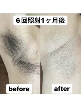 ミノア 大野城店(MINOA)/全身脱毛/脱毛/顔脱毛/VIO脱毛