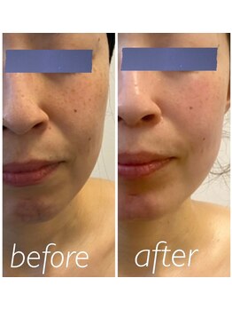 シス(SiS)/ハーブピーリング