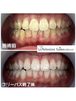 ホワイトニングサロン 京都烏丸店/ホワイトニング施術例