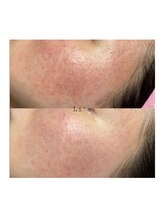 トータルビューティーサロンリア(Li'a)/ビフォーアフター