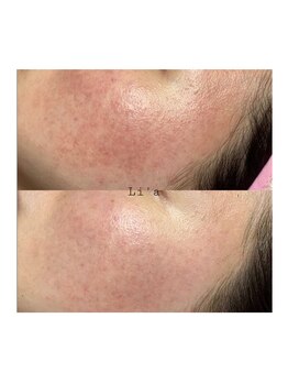 トータルビューティーサロンリア(Li'a)/ビフォーアフター