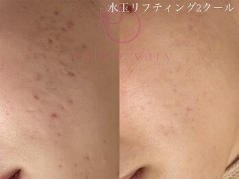 サロンヴェアリー 広尾(salon vary)/水玉リフティング月1/2クール