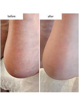 ケアプラス(care plus)/足裏角質ケア