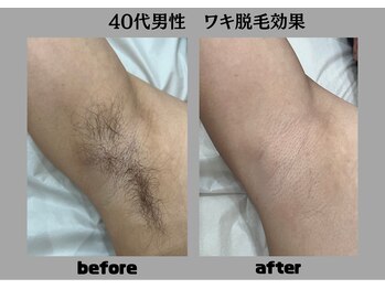 エピリス(EPILIS)/男性☆ワキ脱毛効果☆