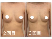 ビーハピネス 京都西院(B-Happiness)/20代3回目