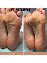マオヌー(MAONU)/韓国式足裏角質ケア　症例写真