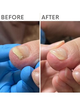 クオッカ(Quokka)/巻き爪ケア