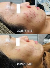 ルーク(Luke)&nbsp;大人女性の ニキビケア