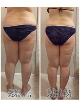 クールスパ(COOL SPA)/40代女性 脚症例