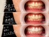 【新規特別価格】《専門機関提携》高効果ホワイトニング3dayプラン55,000円→