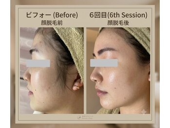 サロンドジェシカの写真/【美肌感アップ◎顔脱毛】　細部のうぶ毛フェイスラインの太めの毛も綺麗に◎顔脱毛シェービング付￥4,900