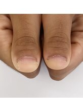 エスミント(S Mint)/初回深爪矯正施術前