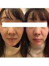 サロン ド シャーロット 恵比寿/韓国肌管理＃水玉SONO(LDM)