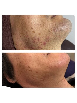 てぃーだ/ヒゲ脱毛