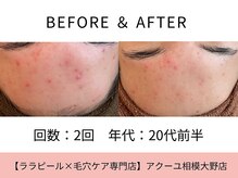 ア クーユ 相模大野店/ハーブピーリング/ニキビケア