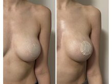 ルナグランデ 心斎橋店(Luna grande.)の雰囲気（【バストアップ10ml】バストNo.1メニュー）