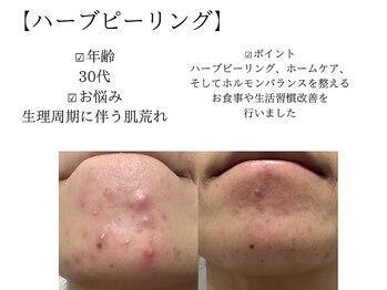 サロンツキ(salon tuki)/ハーブピーリング症例