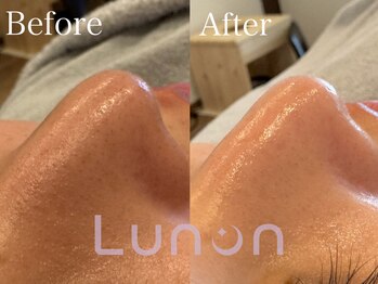 ルノン(Lunon)/毛穴洗浄ハイドロ×ララピール