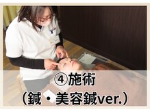 イーグル整骨院 幸町店/大人気美容鍼！