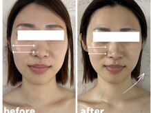 ブルーム(BLOOM)/WISHproビフォーアフター