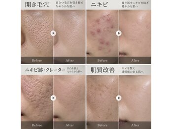 アエ(ae)の写真/ニキビ/跡と開き毛穴をケア◎続けやすい料金で魅力的な肌へ導くエステ以上医療未満★