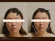 クレスト(CREST)/ビフォーアフター【小顔名古屋】