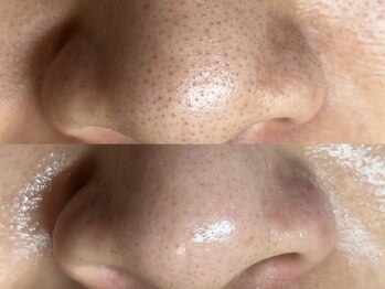 フレーズ(fraise)/毛穴エクストラクション