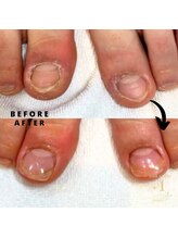 プラスワン(+1)/フット深爪矯正