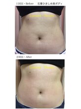 リュミエールボーテ/石膏ボディパック