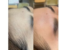 ナチュウル(Natulu)の雰囲気（糸脱毛はフェイシャルWAXに比べて肌への刺激・赤みが少ない☆）