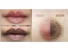 大人気！【ルメラ・ダブルセット】《唇＋乳輪》＋アフタークリーム付￥77000