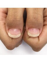 エスミント(S Mint)/4回目深爪矯正終了