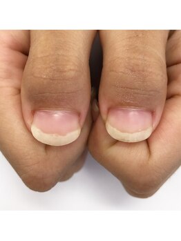 エスミント(S Mint)/4回目深爪矯正終了