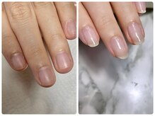 スターネイル(Starnail)/深爪育成　丸爪チビ爪縦長