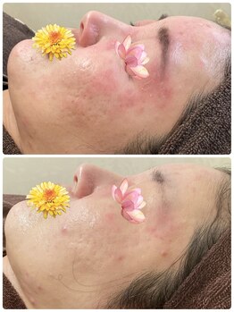 ビエル(Bielle)/進行中の赤み、原因が分からない