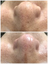 ヒルナム(Heal Nam)/毛穴エクストラクション