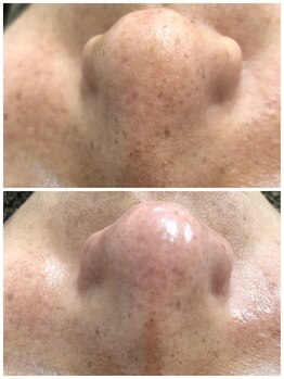 ヒルナム(Heal Nam)/毛穴エクストラクション